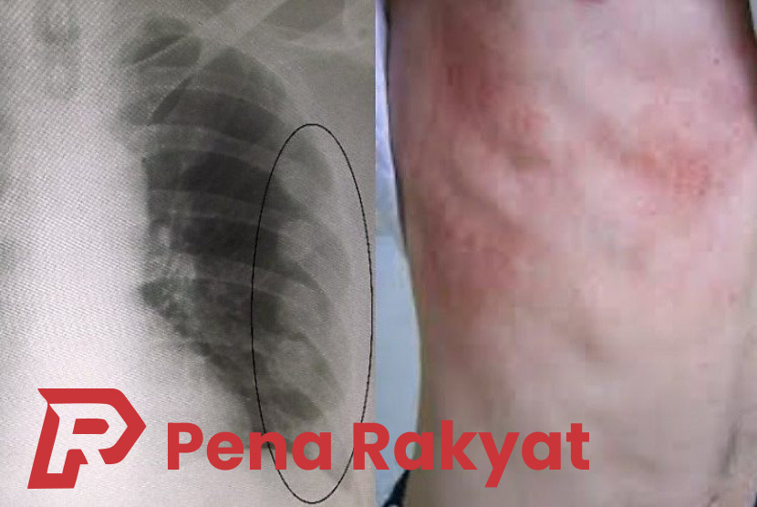 Patah Tulang Iga? RSUD Genteng Siapkan Layanan Pembedahan Terkini