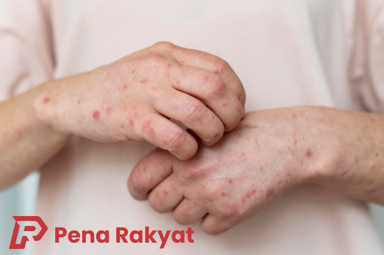 Teknologi Kesehatan Canggih: Solusi Dinkes Banyuwangi Atasi Permasalahan Penyakit Kusta